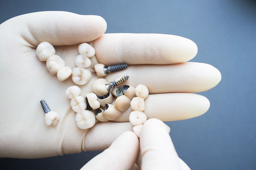 Künstlich einzelne Zähne | Dentallabor Lina Berndt